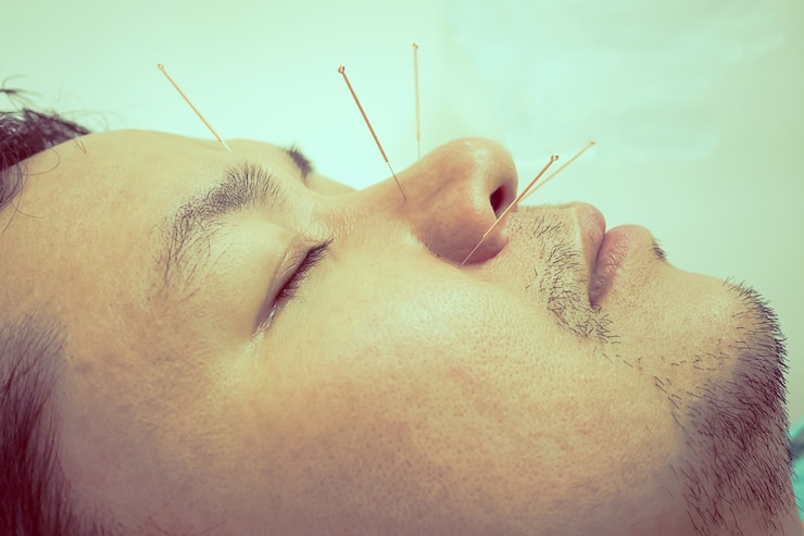 Tap av lukt etter COVID-19: prøv akupunktur !